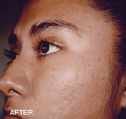 chemical-peels-after