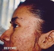 chemical-peels-before