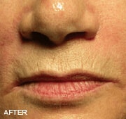 Juvederm