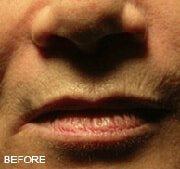 Juvederm