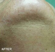 laser-hair-removal-after-1