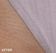 Laser Hair Removal