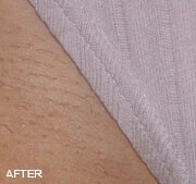 laser-hair-removal-after-2