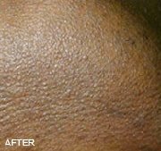 laser-hair-removal-after-3