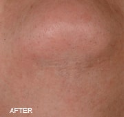 laser-hair-removal-after-5