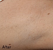 laser-hair-removal-after-6