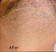 laser-hair-removal-after-7