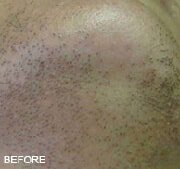 Laser Hair Removal