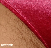 Laser Hair Removal