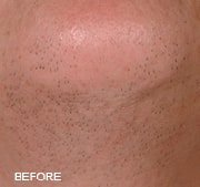 Laser Hair Removal