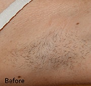 Laser Hair Removal