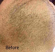 laser-hair-removal-before-7