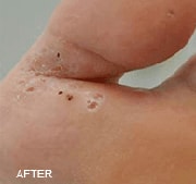 Laser Wart Removal