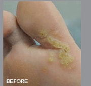 Laser Wart Removal