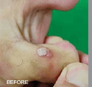 Laser Wart Removal