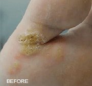 Laser Wart Removal