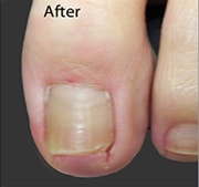 Nail Fungus Treatment