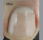 Nail Fungus Treatment