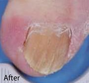 Nail Fungus Treatment