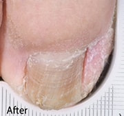 Nail Fungus Treatment