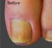 Nail Fungus Treatment