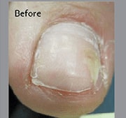 Nail Fungus Treatment