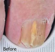 Nail Fungus Treatment