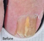 nail-fungus-treatment-before-3