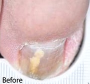 Nail Fungus Treatment