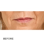 Restylane