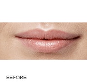 restylane-before-3