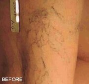 Vein Treatment